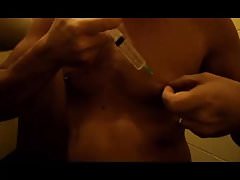 saline injection into the breasts