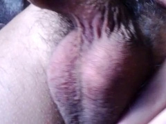 Phimosis, Taut Foreskin, Cum Discharged