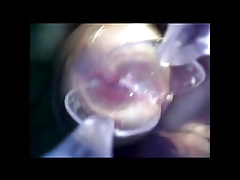 endoscope in 2 spoons push inside urethra cock exploration