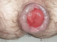 Ass prolapse