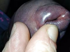 Swollen helmet phimosis nipple close up