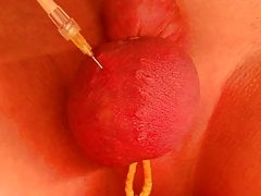 Saline Injection