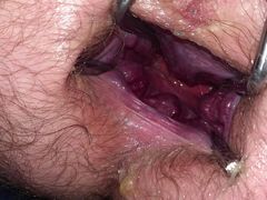 4 inch stretch cauliflower prolapse