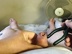 Foreskin with small blue pliers