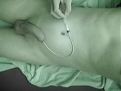 catheter in seminal vesicle