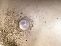 Supple Cups filling up with Serous fluid