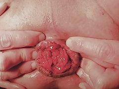 Anal Prolapse Beginners Training