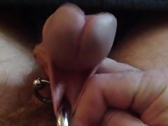 Subincision