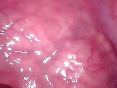 Anal endoscope