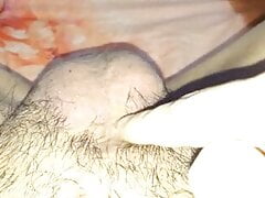 Penectomy radical