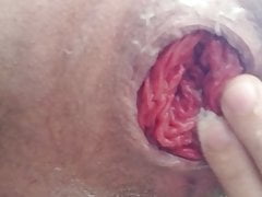 Close up self fisting with anal prolapse